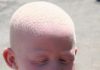MAXAAD KA TAQAAN DADKA LOO YAQAAN ALBINOS- KA ?